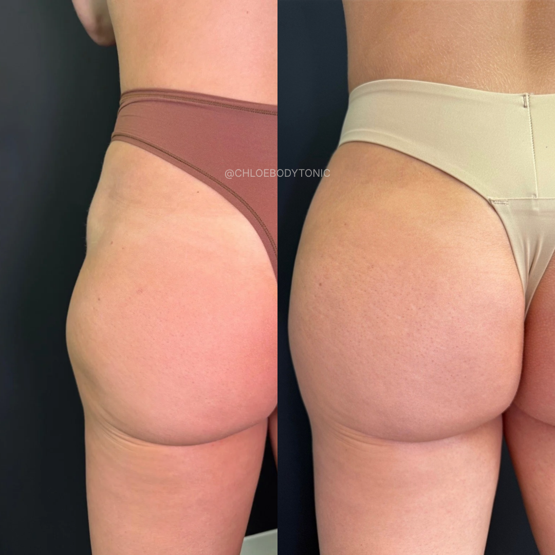 BBL Filler in Austin: Radiesse vs. Sculptra for a Non-Surgical Butt Lift — featured Body Tonic RX journal article, Austin, TX